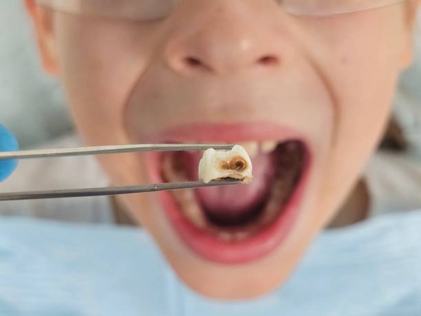 Best Broken or Chipped Tooth Repair in Stinnett, TX